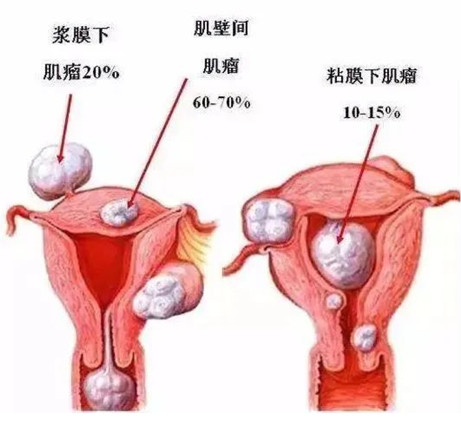 浆膜下子宫肌瘤最常见症状