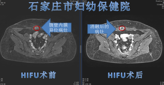 不容忽视的腹壁子宫内膜异位症