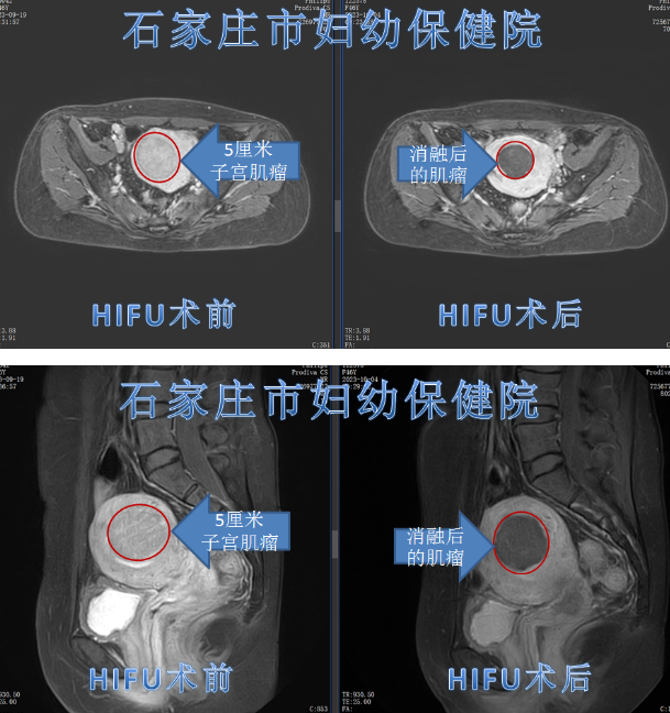 引起出血的粘膜下肌瘤，如何治疗？