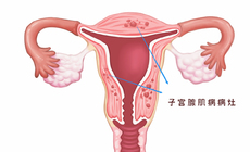 子宮腺肌病嚴重嗎,要怎么治療？