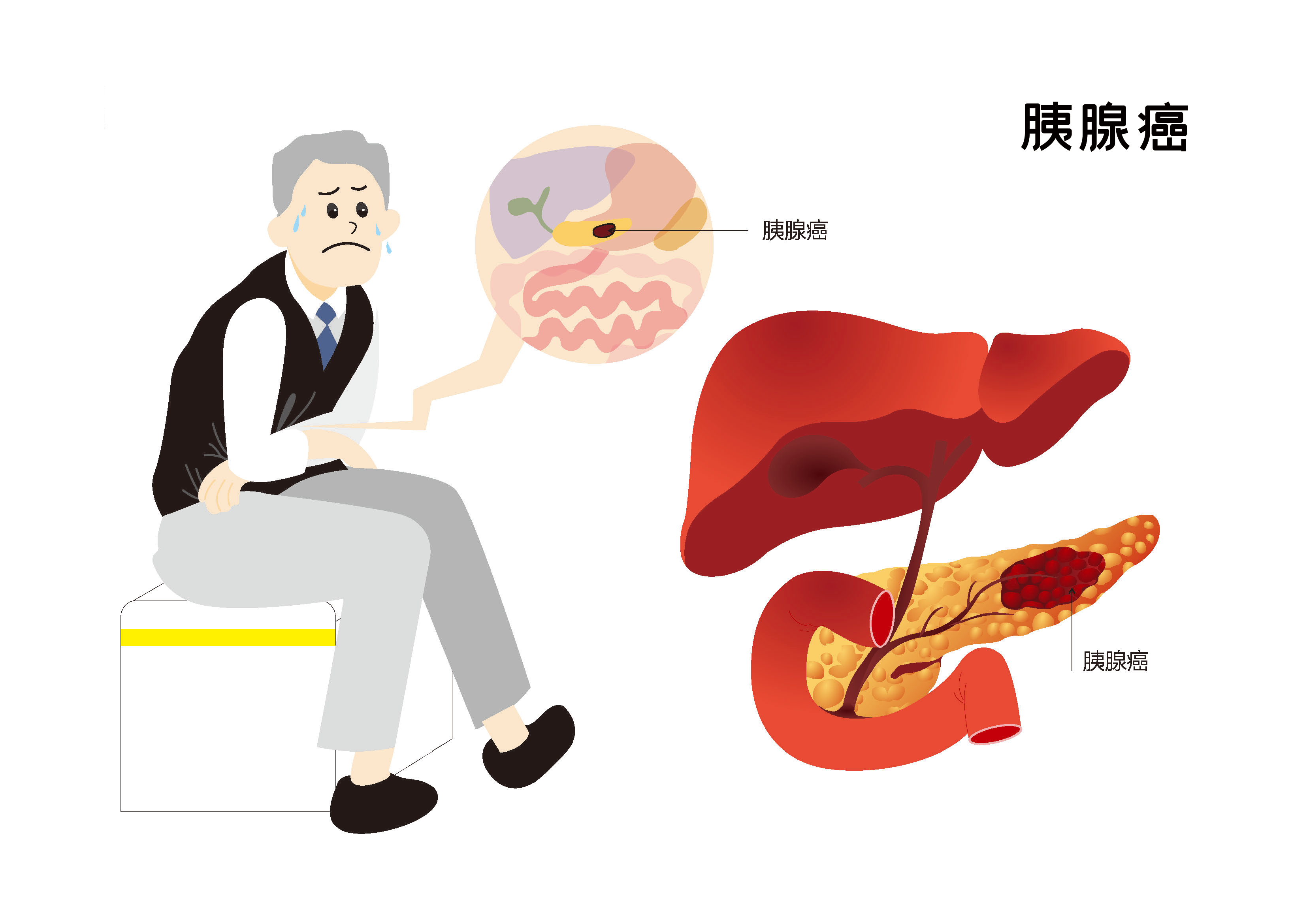 生存率仅为5%的胰腺癌患者，为什么治疗那么难？