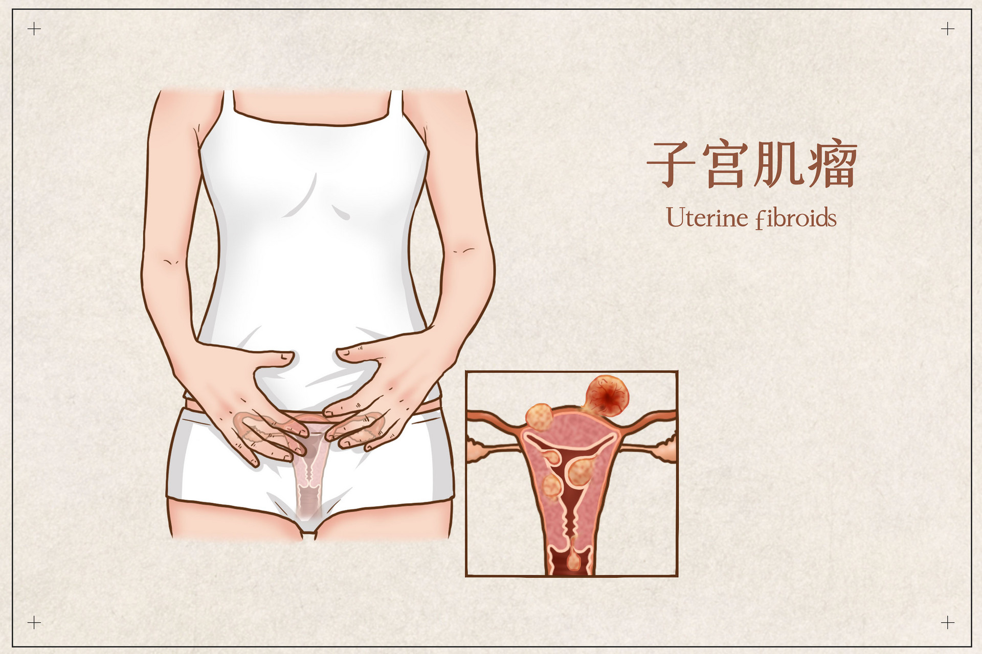 60岁子宫肌瘤多大需要手术