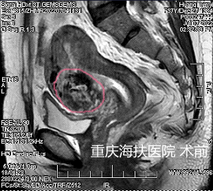 聚焦超声+宫腔镜治疗胎盘植入