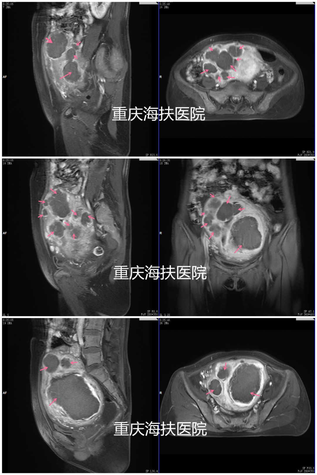 30+个肌瘤，最大超过11cm，还有保宫机会吗？