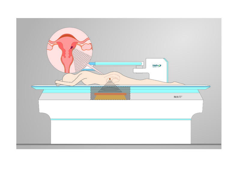 子宫肌瘤进行聚焦超声消融手术后忌口都该忌什么？