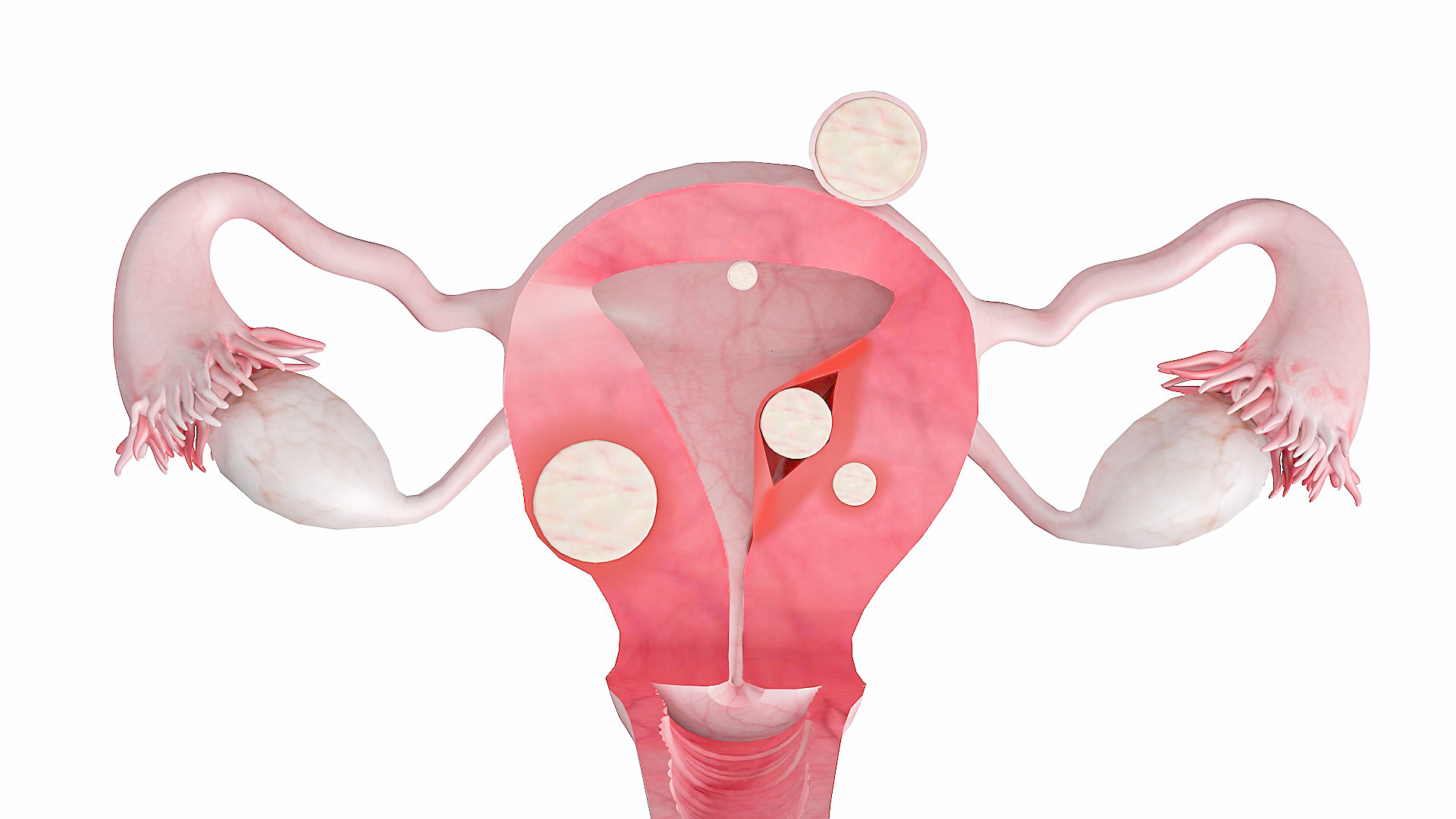 子宫肌瘤的临床症状及变性详解