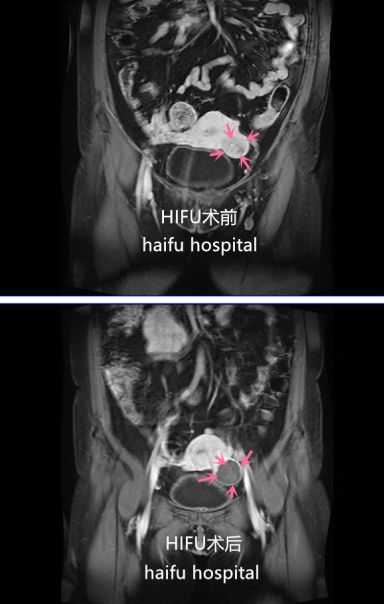 聚焦超声消融术后半年，肌瘤缩小了98%