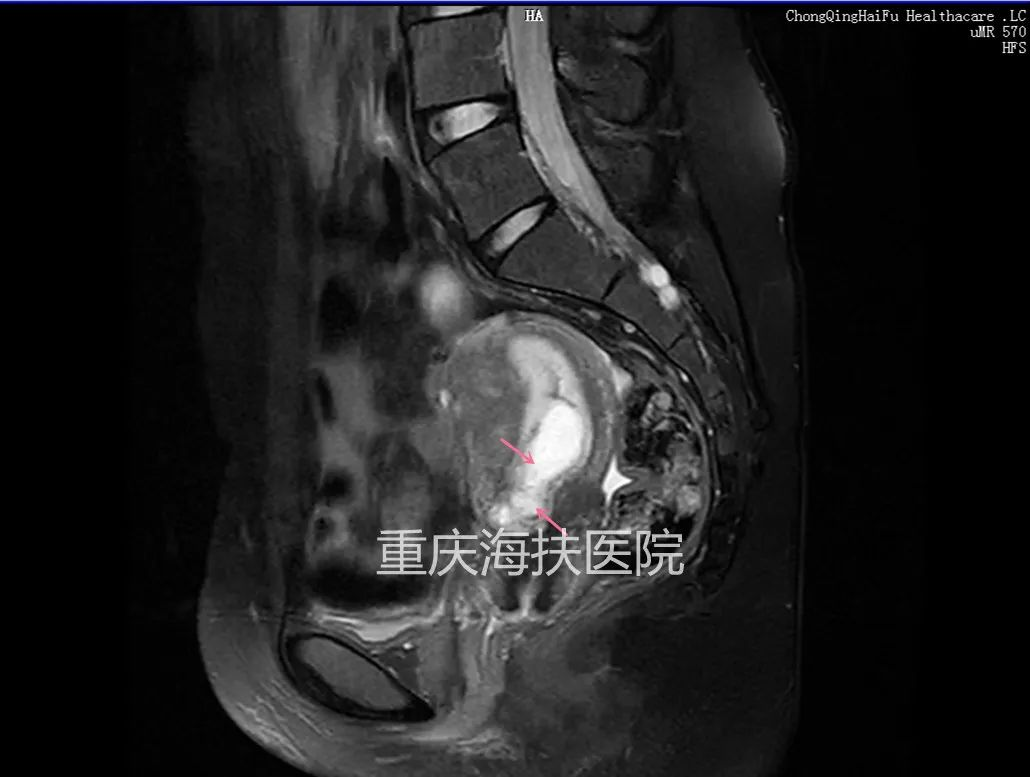 瘢痕妊娠如何化险为夷？看聚焦超声+宫腔镜精准轻松“拆弹”