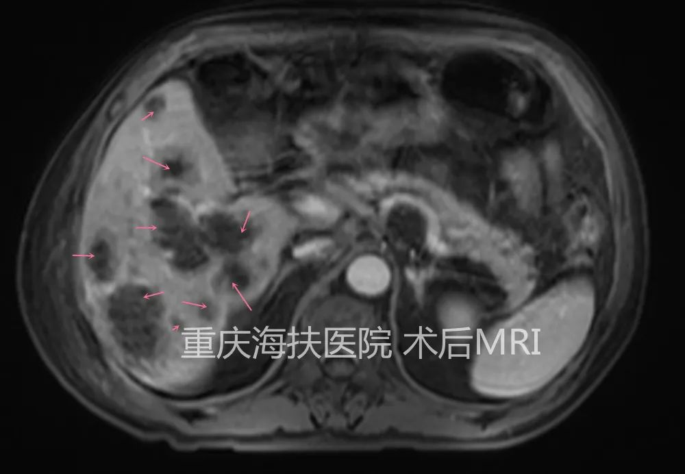 聚焦超声消融转移性肝癌，不开刀，瘤体“伤亡惨重”