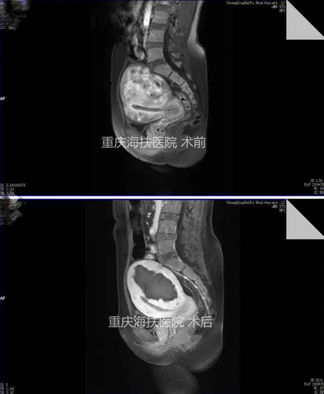 腺肌病痛经14年，经历了输血、打针、安环……