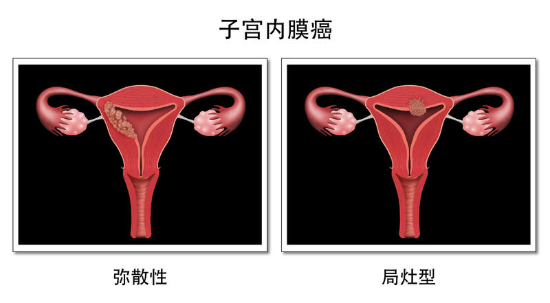 子宫内膜癌早期两大症状，助你及时发现病变！