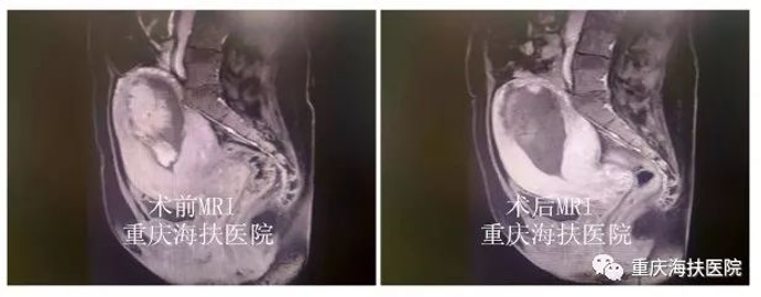 胎盘植入要切子宫？聚焦超声消融手术逆转剧情