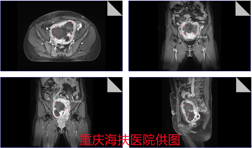 腹腔镜、开腹、再次腹腔镜……她的保宫之路如何走下去？