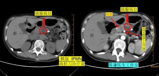 72 岁北京老人跨省求医：胰腺 IPMN 不用开刀，4 个月肿瘤缩小80%