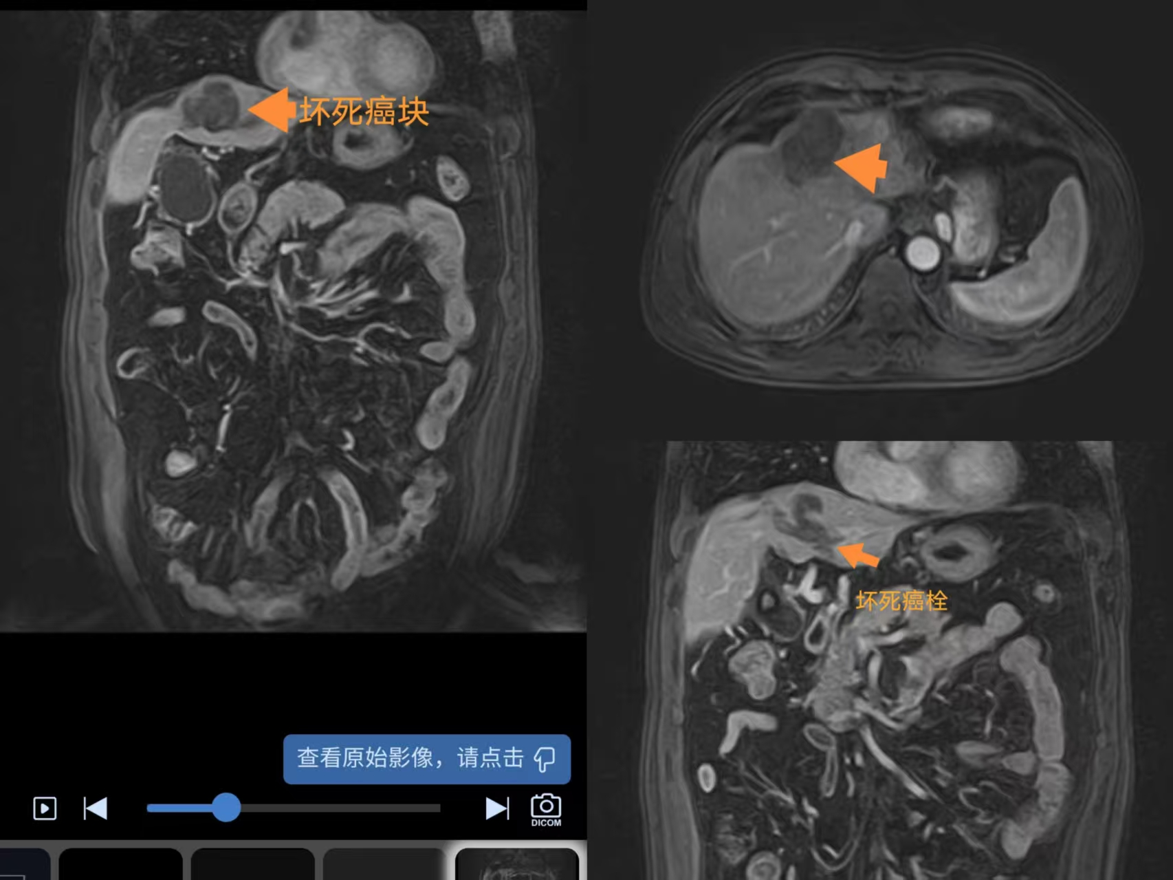 海扶刀进行聚焦超声消融治疗肝细胞癌合并门脉癌栓1年后