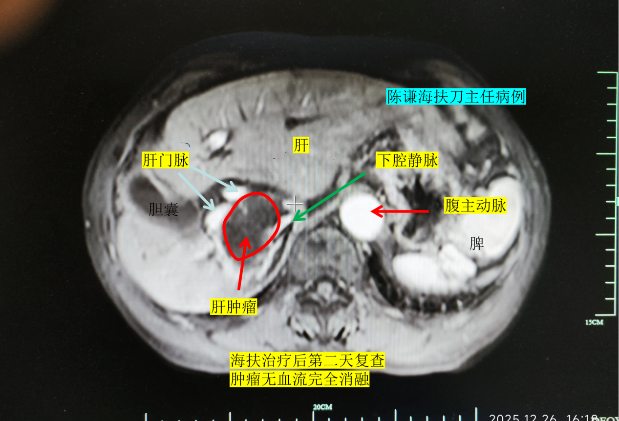 74岁晚期肝癌患者千里求医，海扶刀精准消融特殊部位肿瘤