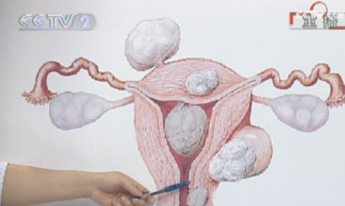 央视：解读子宫肌瘤（上）