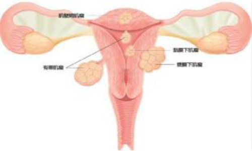 子宫肌瘤的症状有哪些？