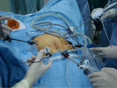 腹腔镜子宫肌瘤剥除术后子宫破裂的影响因素