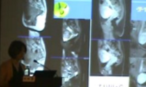 杨利霞：子宫肌瘤和肌腺症的MRI诊断
