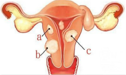 有子宫肌瘤会有哪些症状？