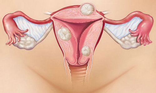 子宫肌瘤的六大常见症状