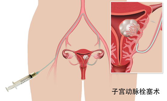 子宫肌瘤，需要挑选最合适的治疗方法