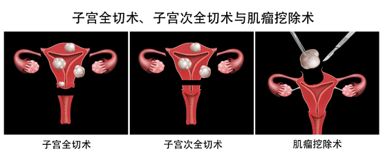 子宫肌瘤，需要挑选最合适的治疗方法