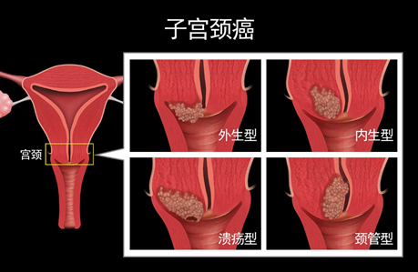 30多岁就患上宫颈癌，宫颈有多脆弱你可知道