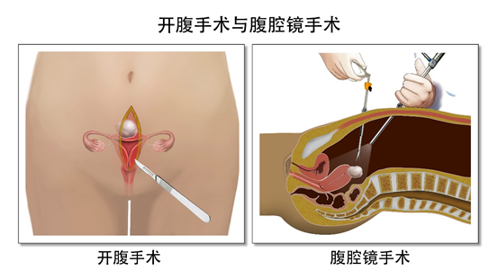 子宫肌瘤超过几厘米需要切除