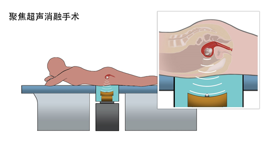 得了子宫腺肌病是一种怎么样的体验