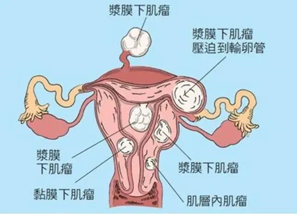 “隐形”手术——海扶刀，轻松为您解决子宫疾病的困扰