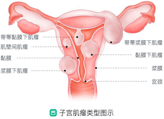 得了子宫肌瘤，就一定要切除子宫么？