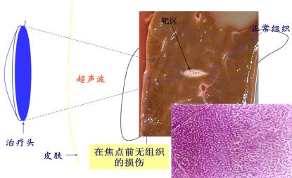 聚焦超声消融治疗后的肌瘤去哪了?