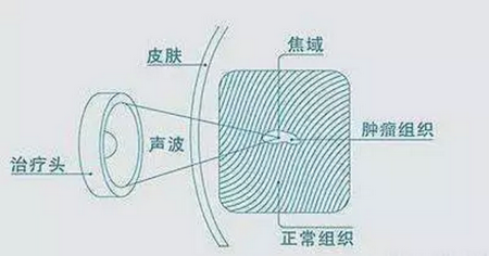 聚焦超声消融治疗会影响月经周期吗？