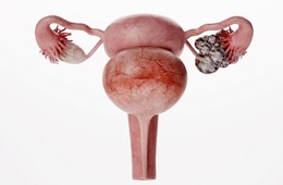 卵巢囊肿主要有这4种表现