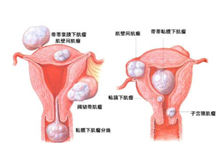 我的10年保宫之路——我是护士，同时也是一名子宫肌瘤患者