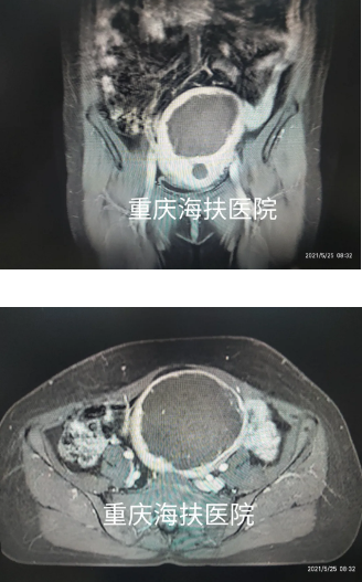 感谢海扶刀®帮我守住两个孩子最初的家