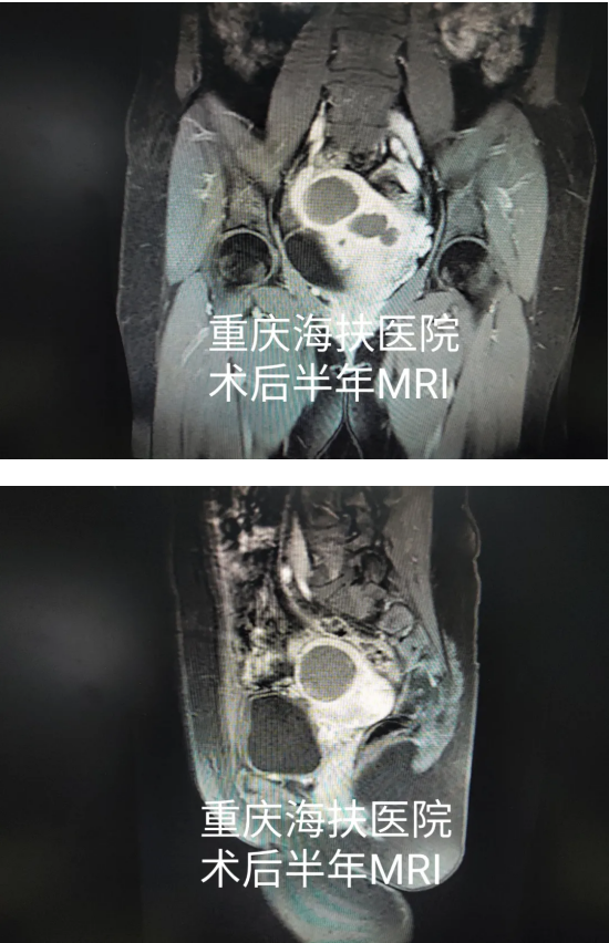 看图说话：聚焦超声消融术后半年