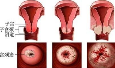 宫颈癌与男性有关系吗？