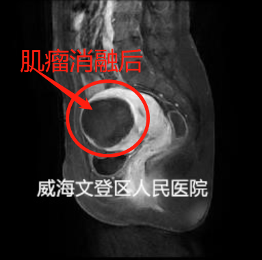 8.2公分富血供子宫肌瘤的聚焦超声消融治疗