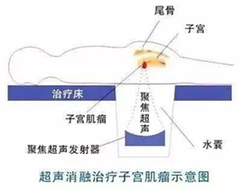 子宫肌瘤难道只能切？切？切？