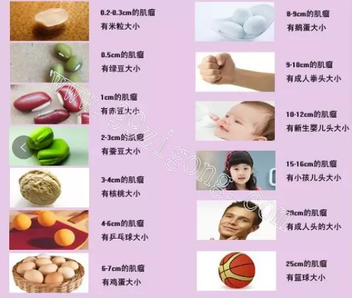 10公分的大肌瘤，我要不要切子宫？