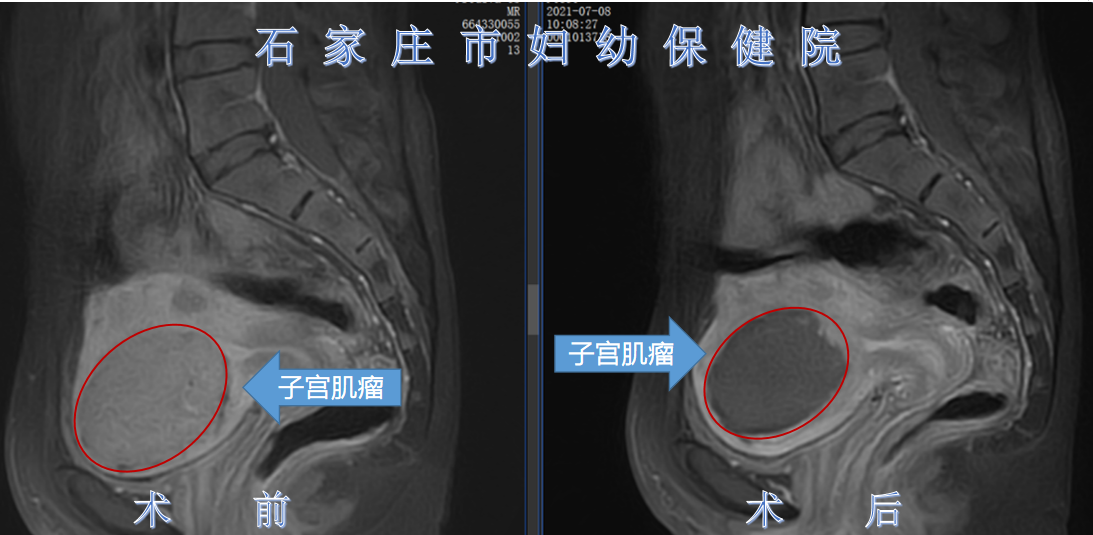 4个子宫肌瘤，最大的6公分，我该怎么办？