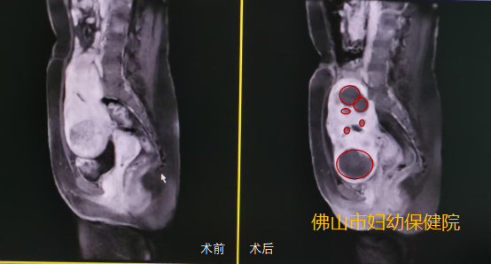 长满肌瘤的子宮还能保留吗?聚焦超声消融手术来帮你