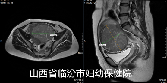 重磅：晋西南首例！看真正的海扶刀如何一次性无创消融10CM以上多发子宫肌瘤？