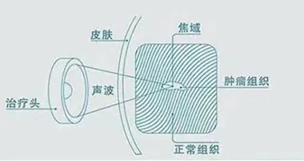 重磅：晋西南首例！看真正的海扶刀如何一次性无创消融10CM以上多发子宫肌瘤？