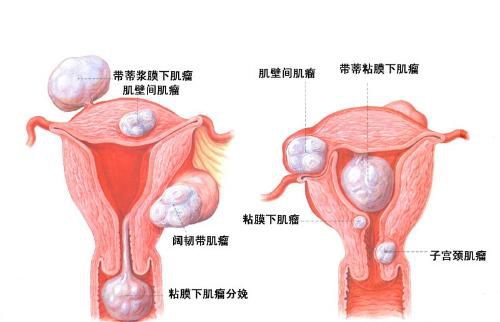 5次胎停，如何圆她的妈妈梦