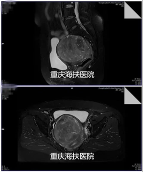 聚焦超声消融技术究竟有多神奇？