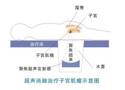 聚焦超声消融技术究竟有多神奇？